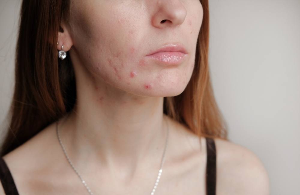 5-things-to-do-to-help-your-acne-go-away-for-good