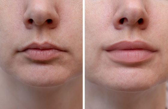 4 Most Popular Lip Fillers that Make Your Pout Last Really Long