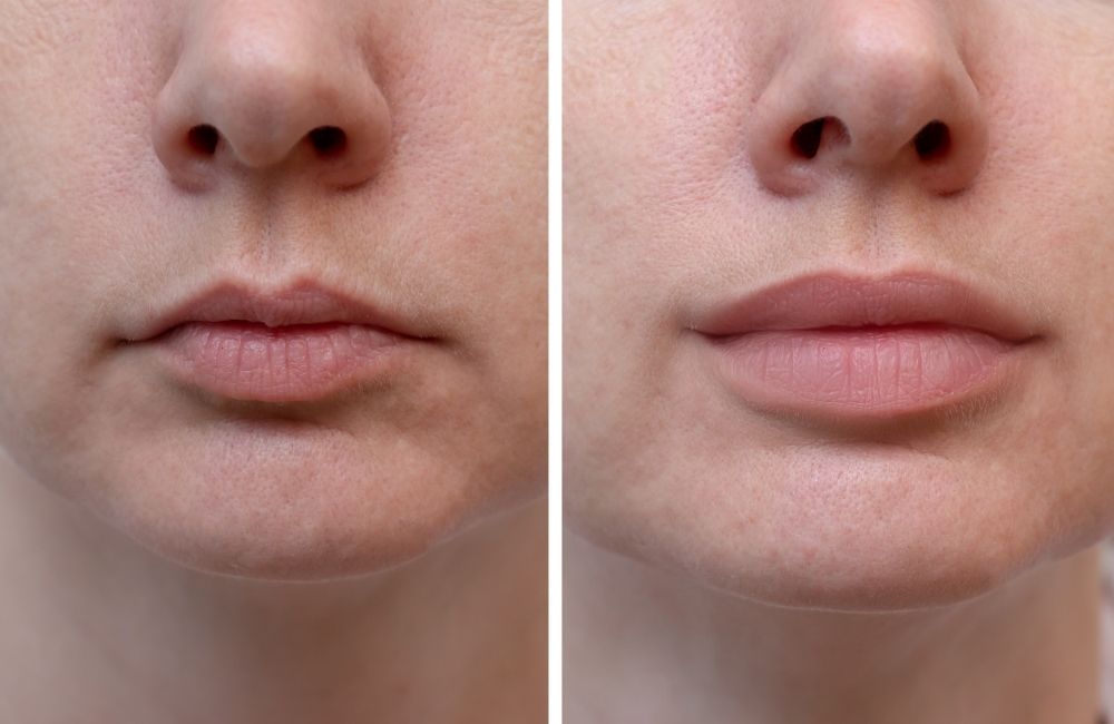 4 Most Popular Lip Fillers that Make Your Pout Last Really Long