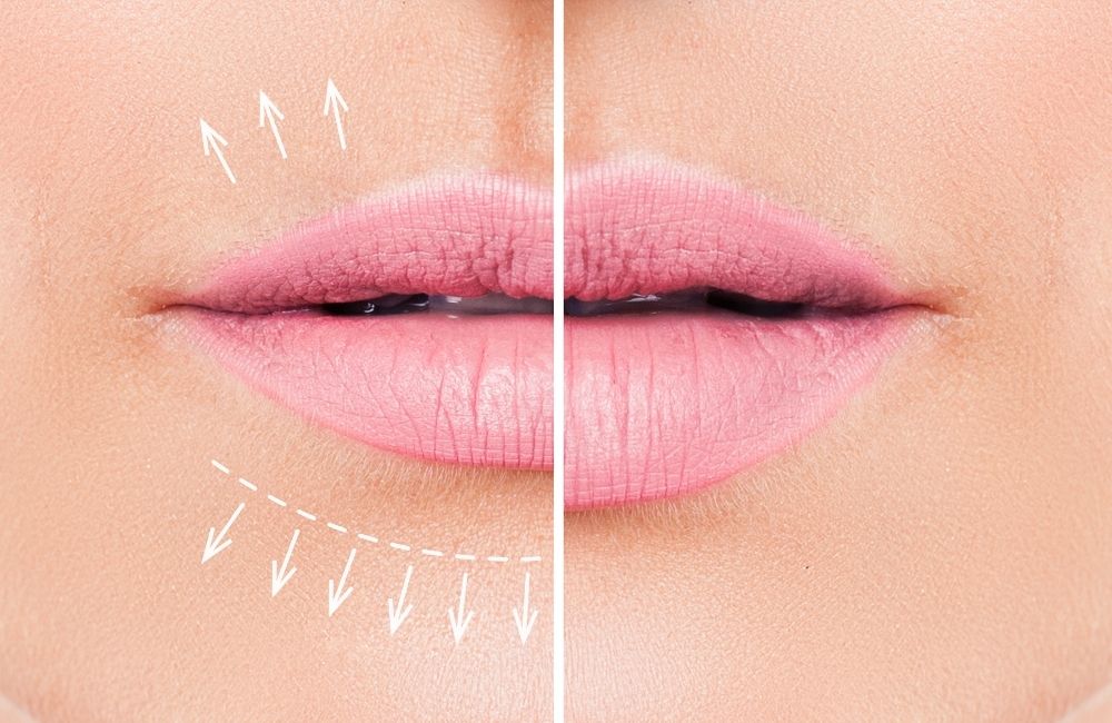 lip filler before and after thin lips