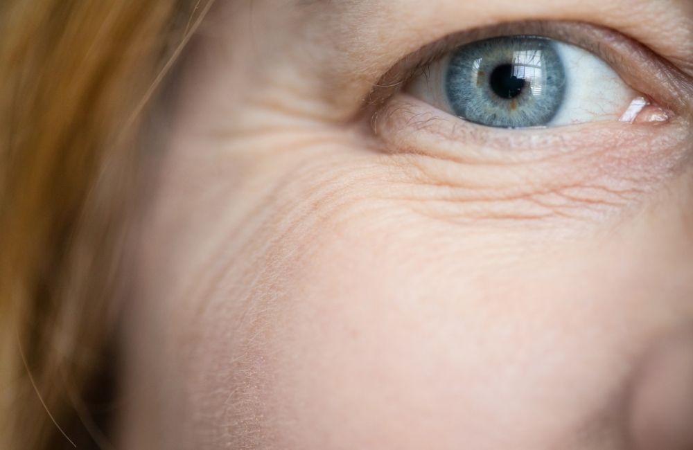 How to Get Rid of Under-Eye Wrinkles Naturally