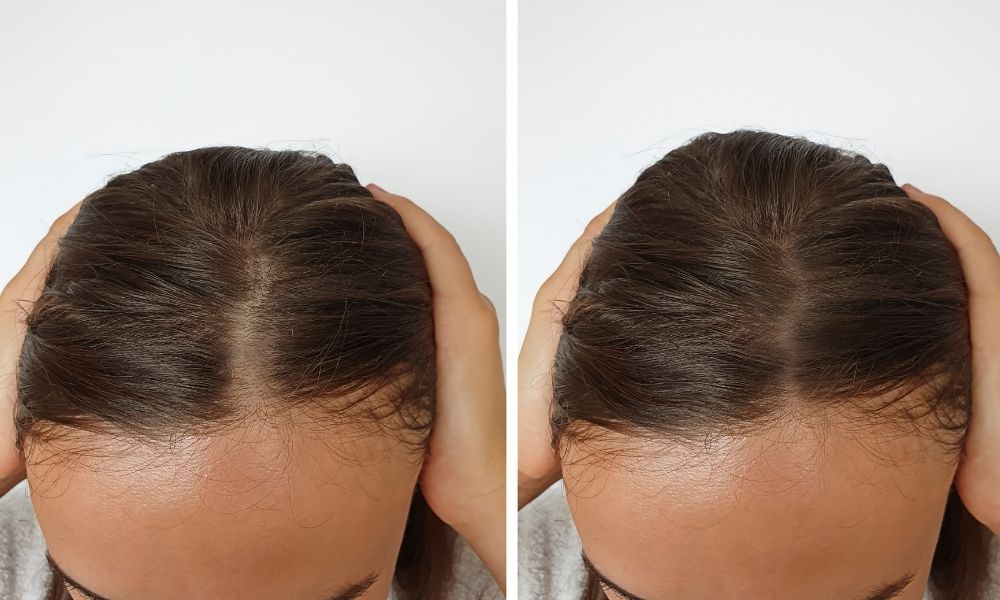 Do Derma Rollers Work For Hair Loss? Find Out Here!