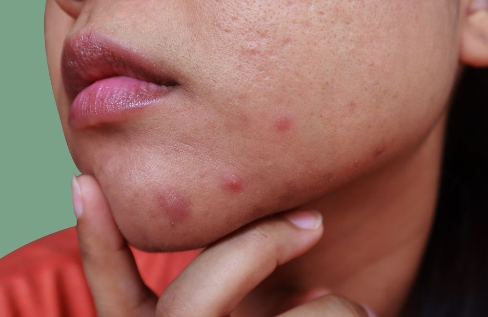 How to Stop Hormonal Acne