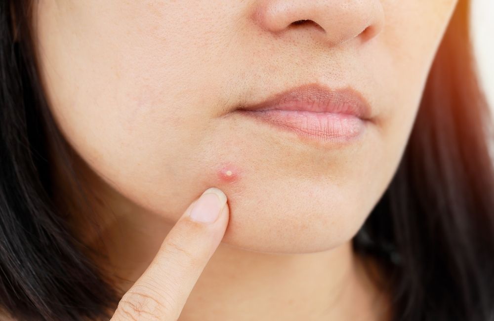 How to Stop Hormonal Acne