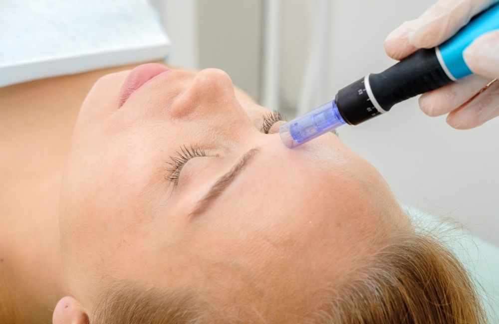 Microneedling