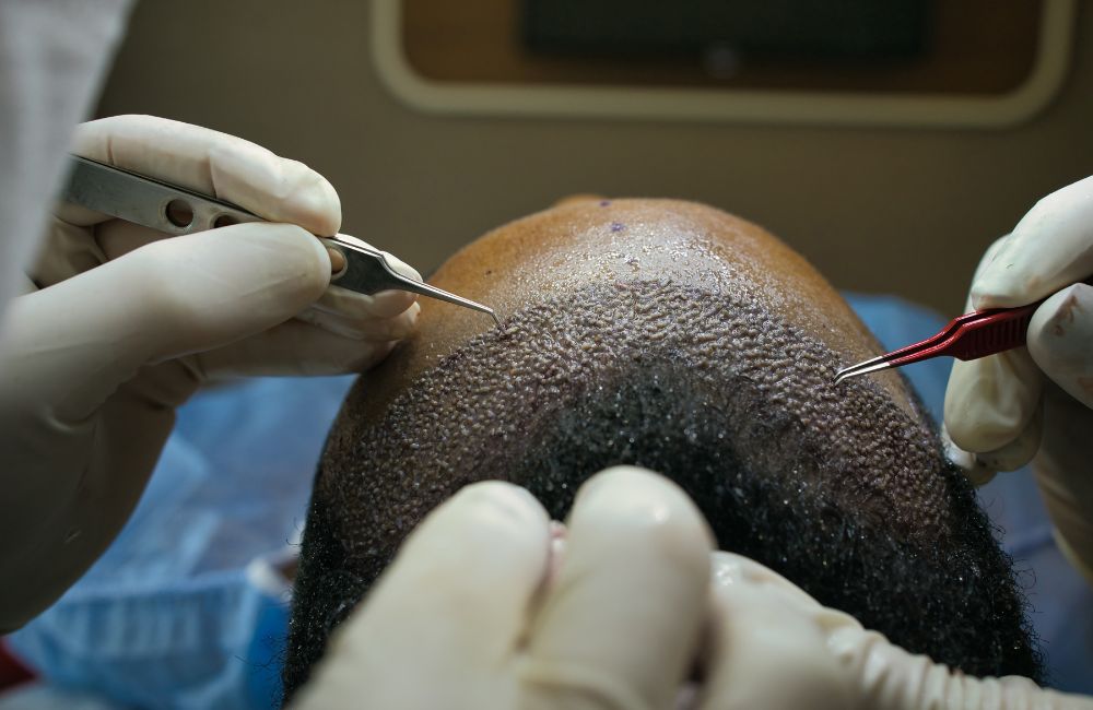 Benefits of Hair Transplant in Poland