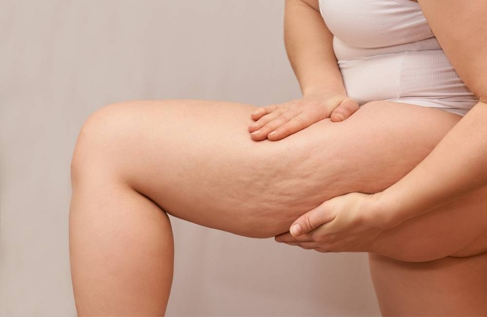 best cosmetic treatments for cellulite