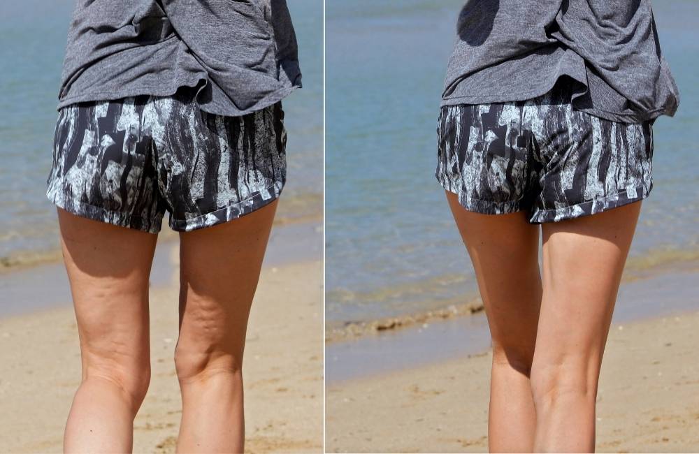 cosmetic cellulite treatment before and after