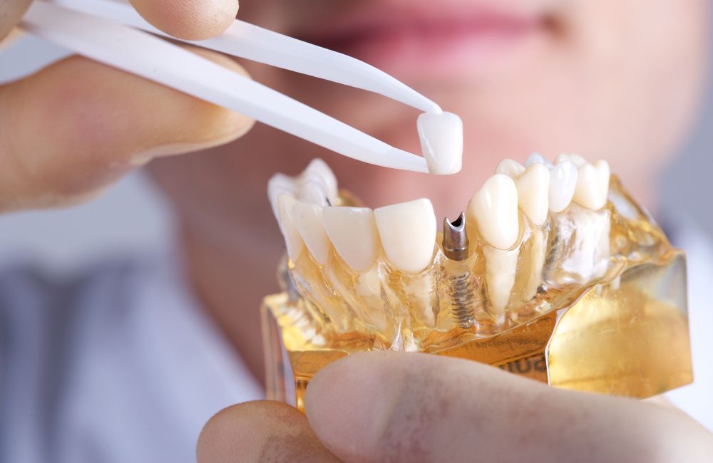 Benefits of All-On-Four Dental Implants