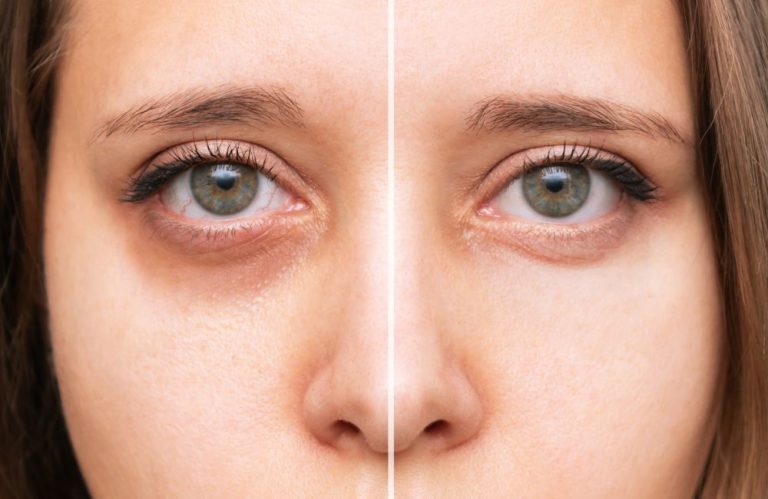 4 Minimally Invasive Treatments For Dark Circles Under Eyes   Minimally Invasive Treatments For Dark Circles Under Eyes 768x499 